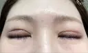 眼瞼下垂（切開） ステラ ロサ クリニック DAY 12 サムネイル用