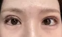 眼瞼下垂（切開） ステラ ロサ クリニック DAY 12 サムネイル用