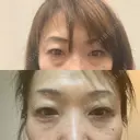 下まぶたの脂肪取り 東郷美容形成外科　福岡 AFTER サムネイル用