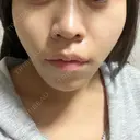 糸リフト TCB東京中央美容外科 池袋駅前院 AFTER サムネイル用