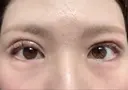 眼瞼下垂（切開） ステラ ロサ クリニック DAY 14 サムネイル用