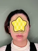 あごプロテーゼ くさのたろうクリニック DAY 27 サムネイル用