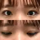 二重埋没 湘南美容クリニック 大阪心斎橋院 DAY 17 サムネイル用
