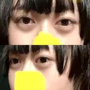 下まぶたたるみ取り / ヒアルロン酸注入（あご） / ボトックス（エラ・小顔） コスメディカルクリニック シンシア 銀座院 DAY 7 サムネイル用