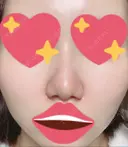 隆鼻術 / 軟骨移植 フェアクリニック川口 DAY 14 サムネイル用