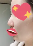 隆鼻術 / 軟骨移植 フェアクリニック川口 DAY 14 サムネイル用