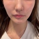 糸リフト / 脂肪吸引（顔） 大阪TAクリニック AFTER サムネイル用