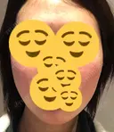 ボトックス（エラ・小顔） コスメディカルクリニック シンシア 銀座院 AFTER サムネイル用