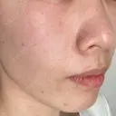 ヴェルヴェットスキン 新宿西口TAKUMI美容クリニック（シンジュクニシグチタクミビヨウクリニック) AFTER サムネイル用