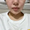 糸リフト / バッカルファット除去 / 脂肪吸引（顔） 湘南美容クリニック 京都院 DAY 37 サムネイル用