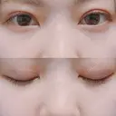 二重埋没 AILE Clinic DAY 26 サムネイル用