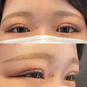二重埋没 / 上まぶたの脂肪取り X CLINIC 福岡天神院 AFTER サムネイル用