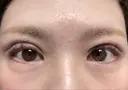 眼瞼下垂（切開） ステラ ロサ クリニック DAY 18 サムネイル用