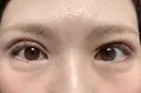 眼瞼下垂（切開） ステラ ロサ クリニック DAY 18 サムネイル用