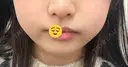ボトックス（エラ・小顔） 湘南美容クリニック 名古屋栄院 DAY 3 サムネイル用