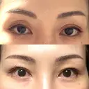 二重埋没 / 眼瞼下垂（非切開） フェアクリニック川口 DAY 7 サムネイル用