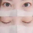 二重埋没 AILE Clinic DAY 27 サムネイル用