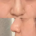 鼻尖形成（切開） / 鼻尖縮小 / その他（鼻） 聖心美容クリニック 札幌院 DAY 494 サムネイル用