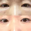 クマ治療 / 脂肪注入（肌） / ボトックス（あご） 銀座みゆき通り美容外科 大阪梅田院 DAY 62 サムネイル用