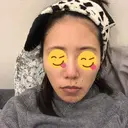 骨切り（あご） / 脂肪吸引（顔） 銀座マイアミ美容外科 AFTER サムネイル用