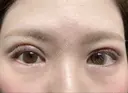 眼瞼下垂（切開） ステラ ロサ クリニック AFTER サムネイル用