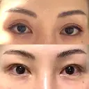 二重埋没 / 眼瞼下垂（非切開） フェアクリニック川口 DAY 11 サムネイル用