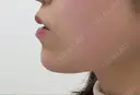 ヒアルロン酸注入（あご） ASTRA BEAUTY CLINIC DAY 0 サムネイル用