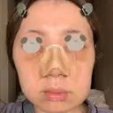 鼻尖形成（切開） / 小鼻縮小（切開） / 軟骨移植 / 骨切幅寄せ / 小鼻縮小（非切開） WOM CLINIC GINZA （ワム クリニック ギンザ） DAY 2 サムネイル用