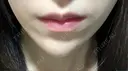ヒアルロン酸注入（あご） ASTRA BEAUTY CLINIC AFTER サムネイル用