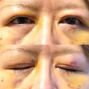 二重切開 / クマ治療 / 上まぶたの脂肪取り / 下まぶたの脂肪取り / その他（目元） ながしまクリニック DAY 6 サムネイル用