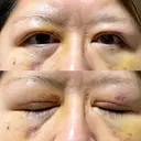 二重切開 / クマ治療 / 上まぶたの脂肪取り / 下まぶたの脂肪取り / その他（目元） ながしまクリニック DAY 7 サムネイル用