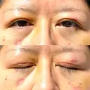二重切開 / クマ治療 / 上まぶたの脂肪取り / 下まぶたの脂肪取り / その他（目元） ながしまクリニック DAY 10 サムネイル用