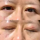 二重切開 / クマ治療 / 上まぶたの脂肪取り / 下まぶたの脂肪取り / その他（目元） ながしまクリニック AFTER サムネイル用