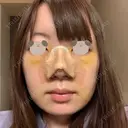鼻尖形成（切開） / 小鼻縮小（切開） / 軟骨移植 / 骨切幅寄せ / 小鼻縮小（非切開） WOM CLINIC GINZA （ワム クリニック ギンザ） AFTER サムネイル用