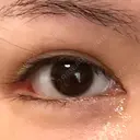 目頭切開 / 目尻切開 / 目尻靭帯移動 FROM B整形外科 (旧バウム整形外科) DAY 72 サムネイル用