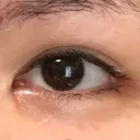 目頭切開 / 目尻切開 / 目尻靭帯移動 FROM B整形外科 (旧バウム整形外科) DAY 72 サムネイル用