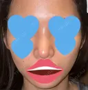 隆鼻術 / 鼻尖形成（切開） / 糸リフト / 軟骨移植 / ヒアルロン酸注入（頬） ASTRA BEAUTY CLINIC AFTER サムネイル用