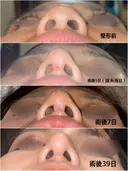 隆鼻術 / 鼻尖形成（切開） / 糸リフト / 軟骨移植 / ヒアルロン酸注入（頬） ASTRA BEAUTY CLINIC DAY 42 サムネイル用