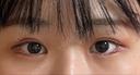 ヒアルロン酸注入（涙袋） プリモ麻布十番クリニック DAY 12 サムネイル用