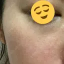 シミ取りレーザー / ピコレーザートーニング（美白・肝斑） Olino美容外科・美容皮膚科 DAY 6 サムネイル用