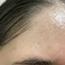 シミ取りレーザー / ピコレーザートーニング（美白・肝斑） Olino美容外科・美容皮膚科 DAY 6 サムネイル用