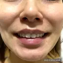 口角挙上 ヴェリテクリニック 名古屋院 DAY 72 サムネイル用