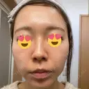 ダーマペン たかだウロクリニック DAY 8 サムネイル用