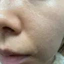 ダーマペン たかだウロクリニック DAY 8 サムネイル用