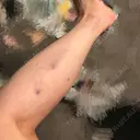 ボトックス（ふくらはぎ） / 脂肪溶解注射 チョンダムheal医院 DAY 3 サムネイル用