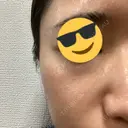 シミ取りレーザー / ピコレーザートーニング（美白・肝斑） Olino美容外科・美容皮膚科 DAY 7 サムネイル用