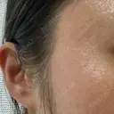 シミ取りレーザー / ピコレーザートーニング（美白・肝斑） Olino美容外科・美容皮膚科 DAY 7 サムネイル用