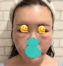 糸リフト / クマ治療 / 脂肪吸引（顔） / 脂肪注入（額） / ヒアルロン酸注入（あご） / ボトックス（エラ・小顔） / 脂肪注入（輪郭） / ボトックス（額） X CLINIC 福岡天神院 DAY 1 サムネイル用