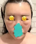 糸リフト / クマ治療 / 脂肪吸引（顔） / 脂肪注入（額） / ヒアルロン酸注入（あご） / ボトックス（エラ・小顔） / 脂肪注入（輪郭） / ボトックス（額） X CLINIC 福岡天神院 DAY 2 サムネイル用