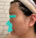 糸リフト / クマ治療 / 脂肪吸引（顔） / 脂肪注入（額） / ヒアルロン酸注入（あご） / ボトックス（エラ・小顔） / 脂肪注入（輪郭） / ボトックス（額） X CLINIC 福岡天神院 DAY 2 サムネイル用